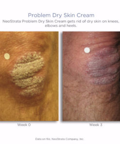 Problem Dry Skin Cream