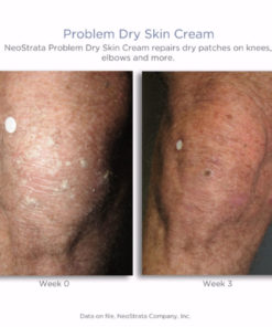 Problem Dry Skin Cream