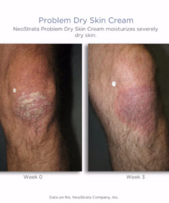 Problem Dry Skin Cream