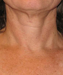 Triple Firming Neck Cream - Semana 0